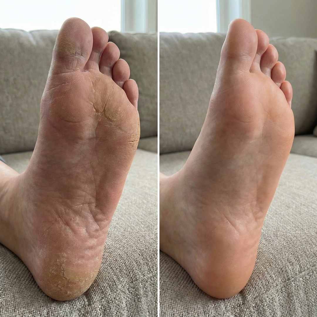 Cali Electric Callus Remover - Image 9