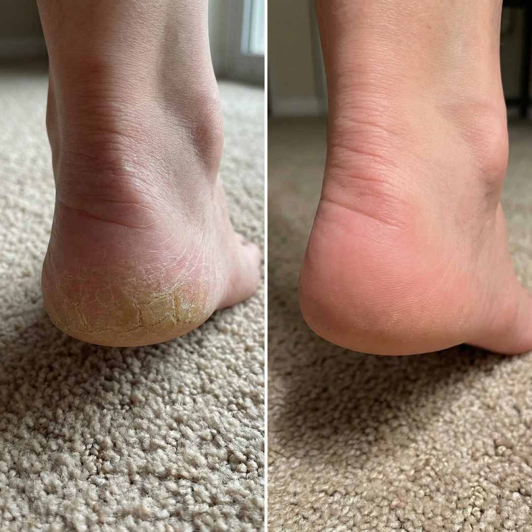 Cali Electric Callus Remover - Image 21